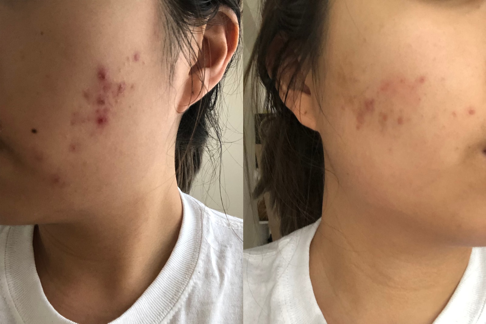curology superbottle cleanser moisturizer review trial effects results pictures hormonal acne skincare clear skin treatment face wrinkles scars 