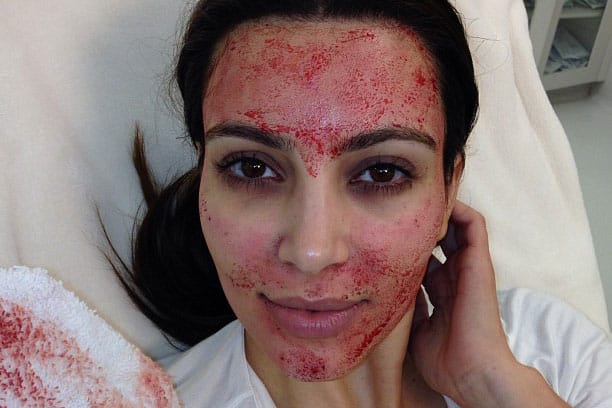 I Tried the Kim Kardashian Vampire Facial — Here's What Happened