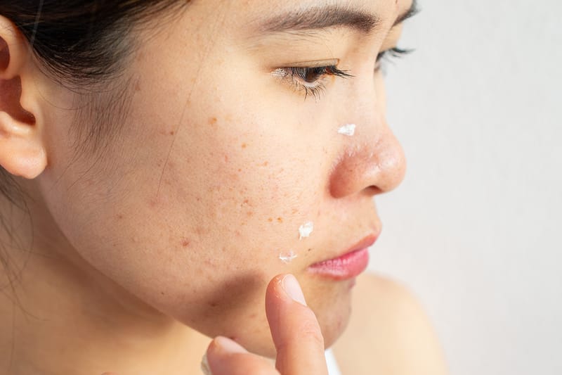 5 Skincare Ingredients to Avoid If You Have Acne-Prone Skin