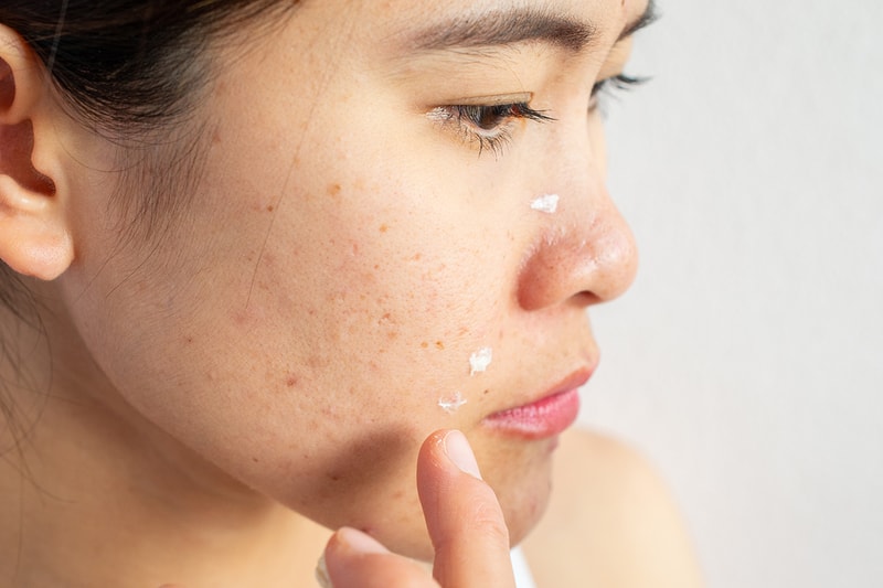 Acne Pimple Woman Cream Skin Skincare