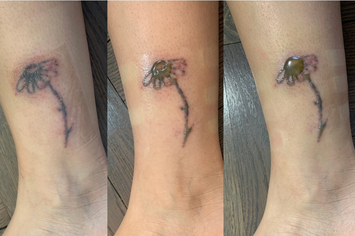 Laser Tattoo Removal What To Expect My Experience Iicf