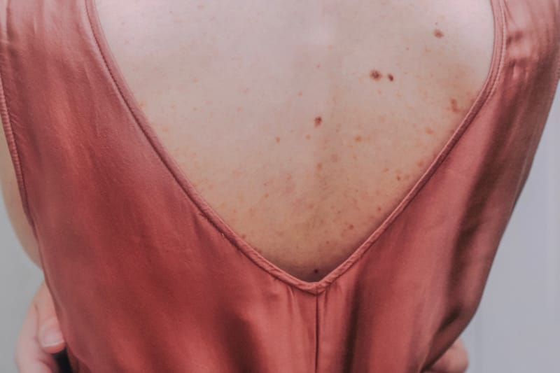 Everything You Need To Know About Body Acne