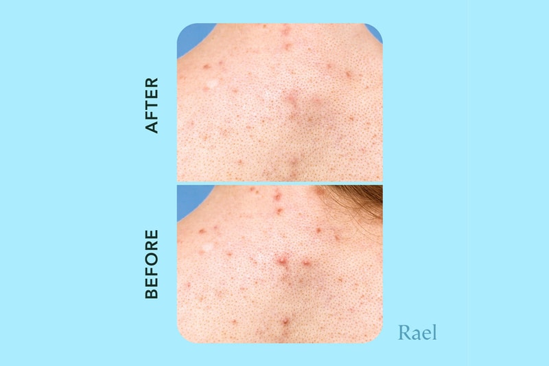 Rael miracle patch xl spot control cover before and after