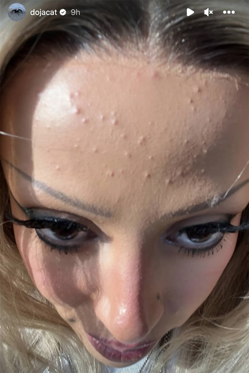 Doja Cat Acne Skincare Selfie iHeartRadio Awards Instagram Photos