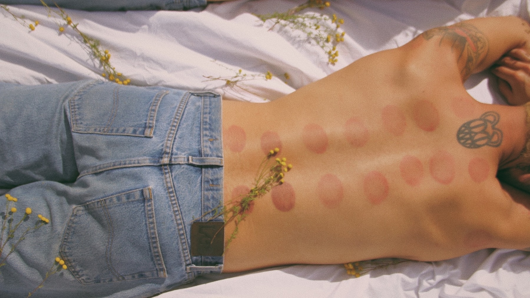 Mount Sunny Cupping Marks Stagnation Health
