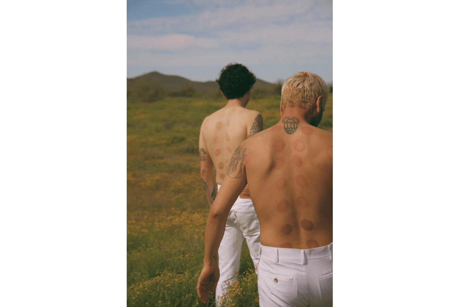 Mount Sunny Cupping Marks Stagnation Health