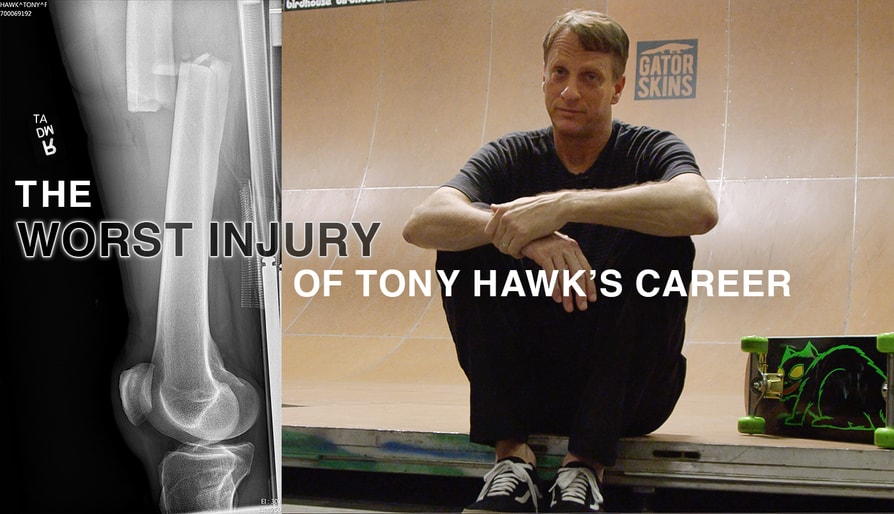 Tony Hawk Breaks Down His Worst Injury