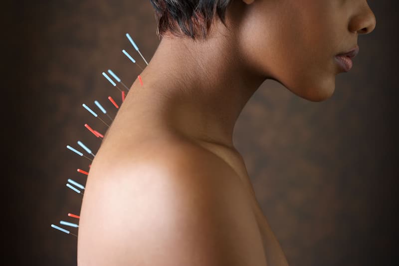 Woman Acupuncture