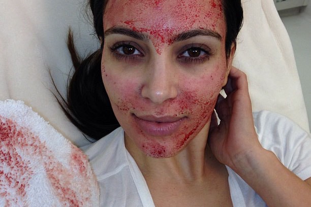 Kim Kardashian Is Suing Doctor Over the Famous "Vampire Facial"