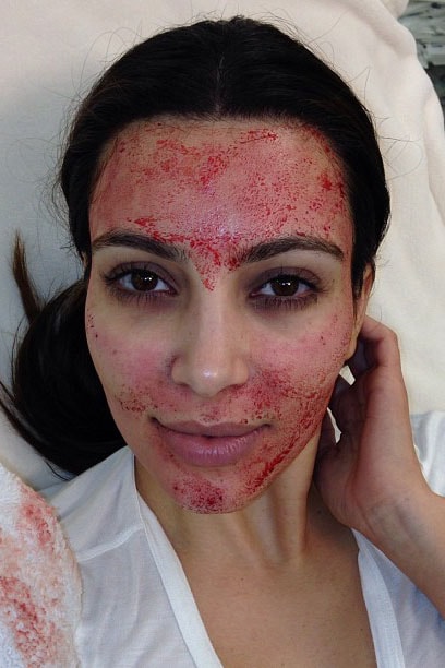 Kim Kardashian Files Lawsuit for Vampire Facial Doctor Copyright Claims False Marketing Skincare Procedure Doctor Charles Runels