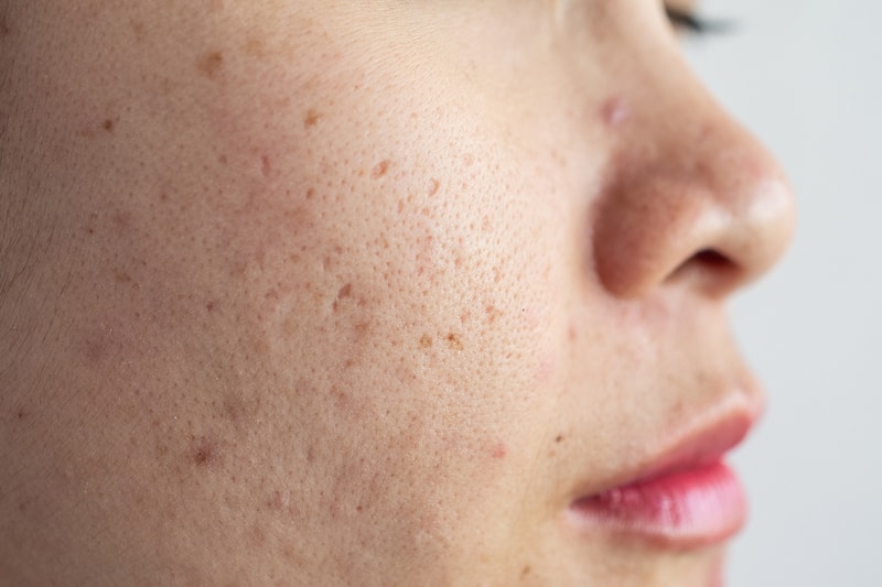 cystic acne skin problems pimples scars redness