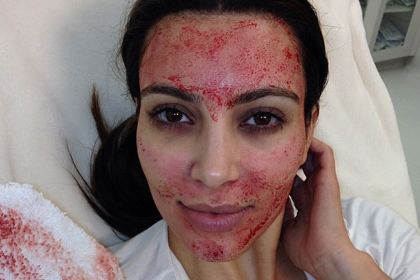 Kim Kardashian Vampire Facial PRP Microneedling