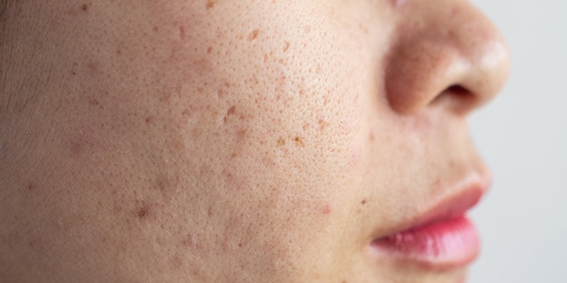 The Top Cystic Acne Treatments and Tips by Dermatologists