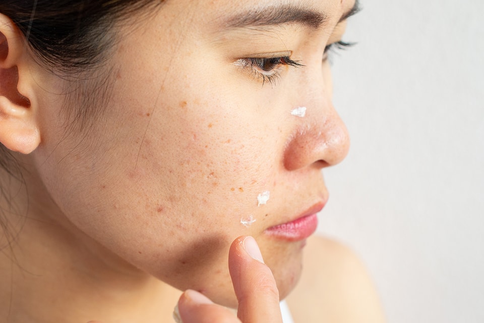 Ingredients To Avoid If You Have Acne Prone Skin Hypebae