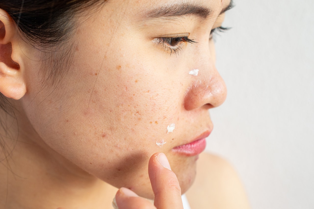 Acne Pimple Woman Cream Skin Skincare