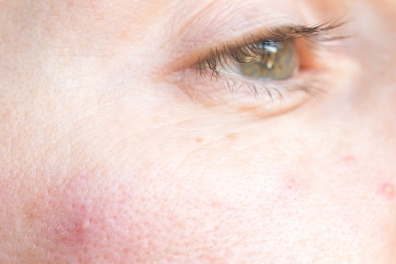 What Is Rosacea and How to Keep It Under Control, According to the Experts