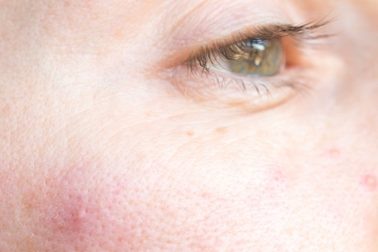 What Is Rosacea and How to Keep It Under Control, According to the Experts