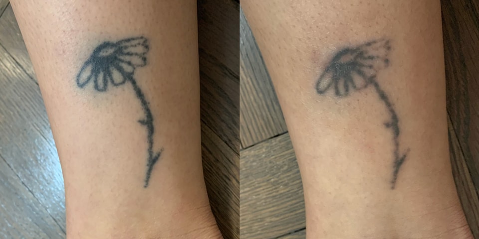 Laser Tattoo Removal What To Expect My Experience Hypebae