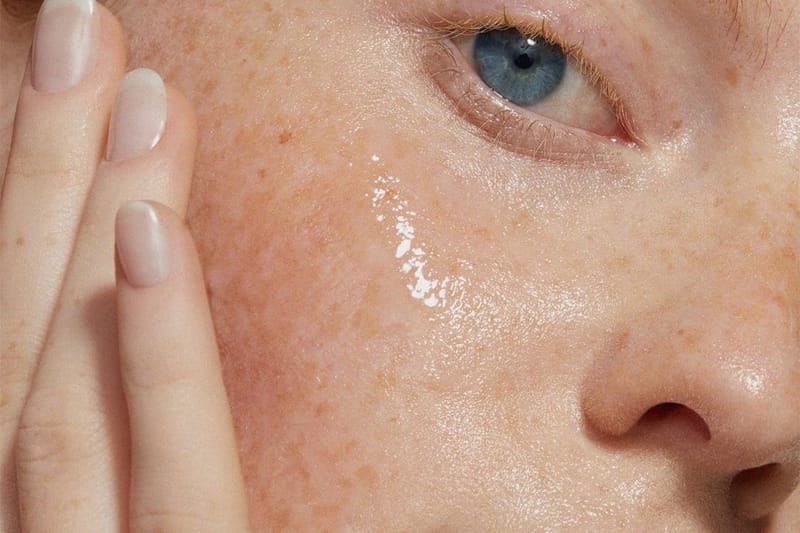 Treatments for Cystic Acne - Forefront Dermatology