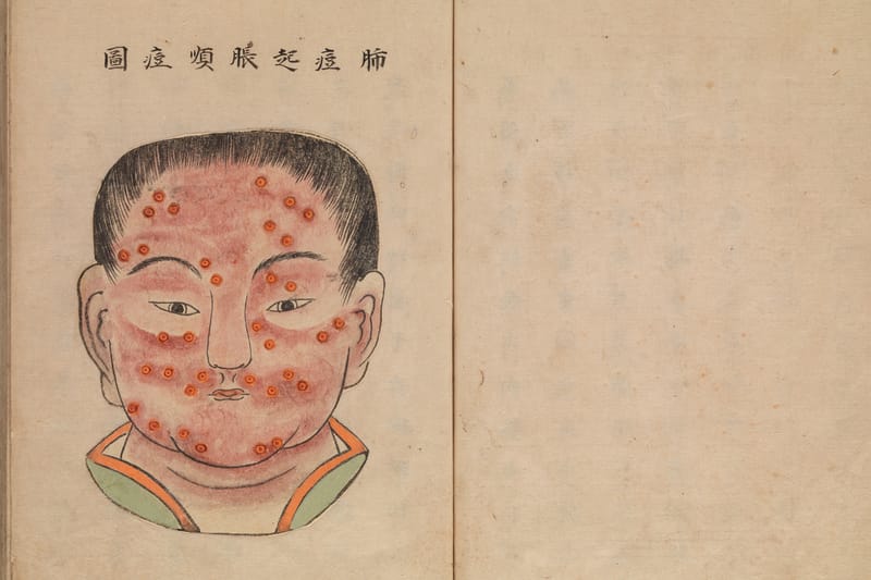 Gambaran Penyakit Cacar Versi Manuskrip Medis Jepang Era 1720-an
