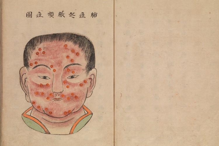 Gambaran Penyakit Cacar Versi Manuskrip Medis Jepang Era 1720-an