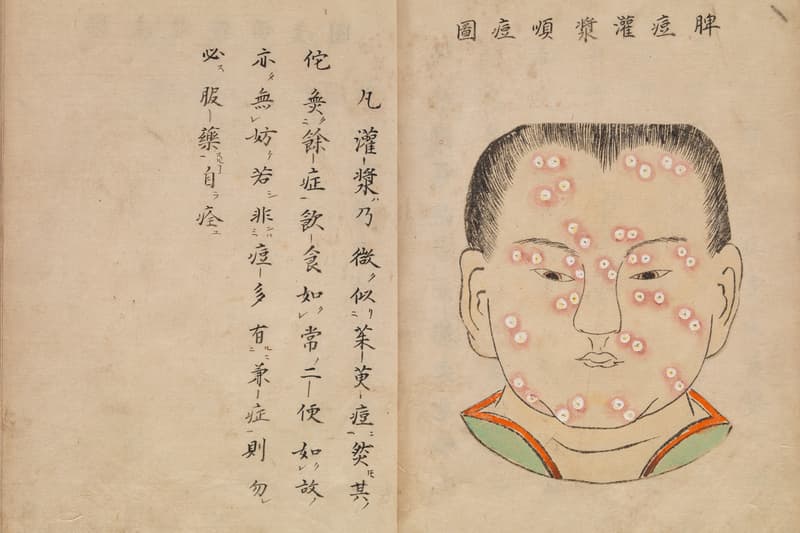 Gambaran Penyakit Cacar Versi Manuskrip Medis Jepang Era 1720-an