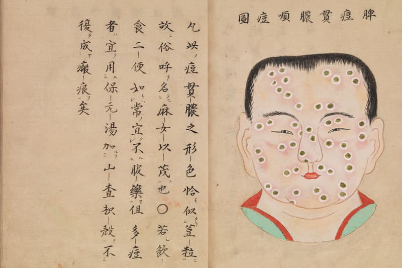 Gambaran Penyakit Cacar Versi Manuskrip Medis Jepang Era 1720-an