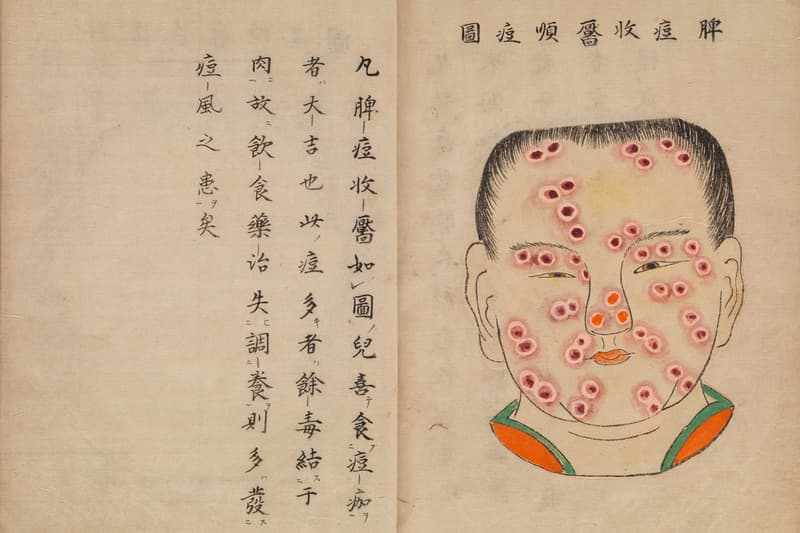 Gambaran Penyakit Cacar Versi Manuskrip Medis Jepang Era 1720-an