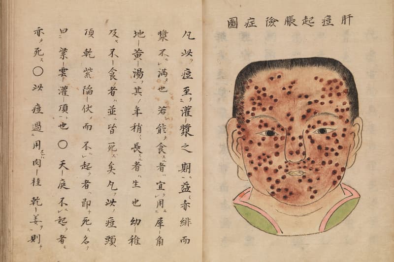 Gambaran Penyakit Cacar Versi Manuskrip Medis Jepang Era 1720-an