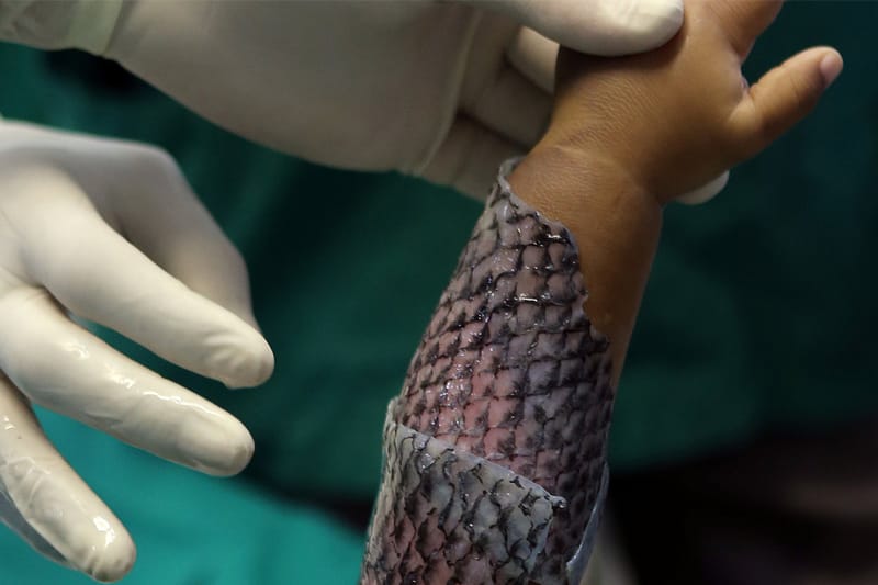 <아쿠아맨>처럼 화상 환자를 치유하는 방법