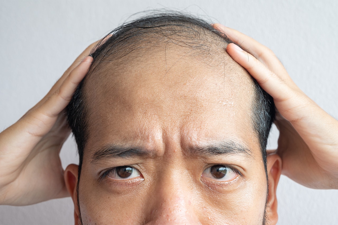 예일대 연구, 탈모 환자 3명 중 1명 머리카락 나게 한 치료제의 정체는?