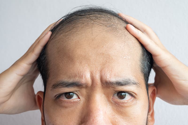 예일대 연구, 탈모 환자 3명 중 1명 머리카락 나게 한 치료제의 정체는?