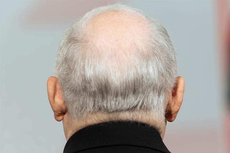 담배 10개비 이상 피우는 남성, 대머리 될 확률 두 배 더 높다