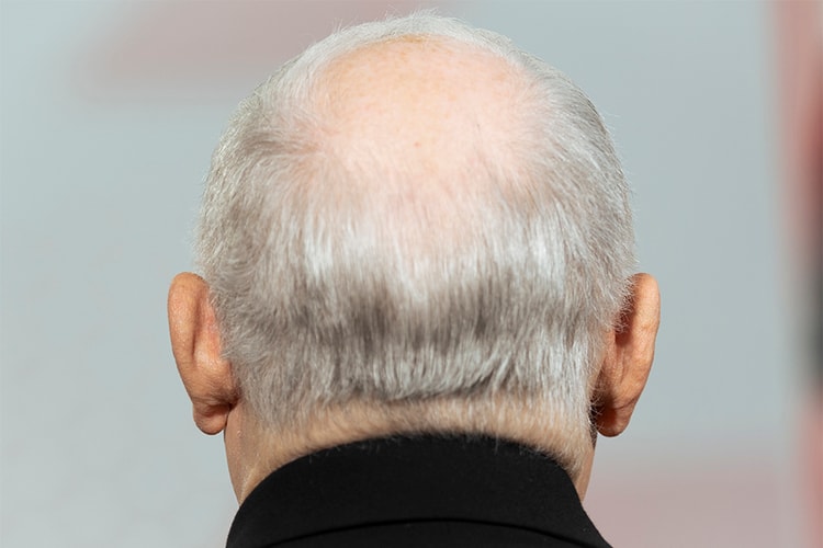 담배 10개비 이상 피우는 남성, 대머리 될 확률 두 배 더 높다