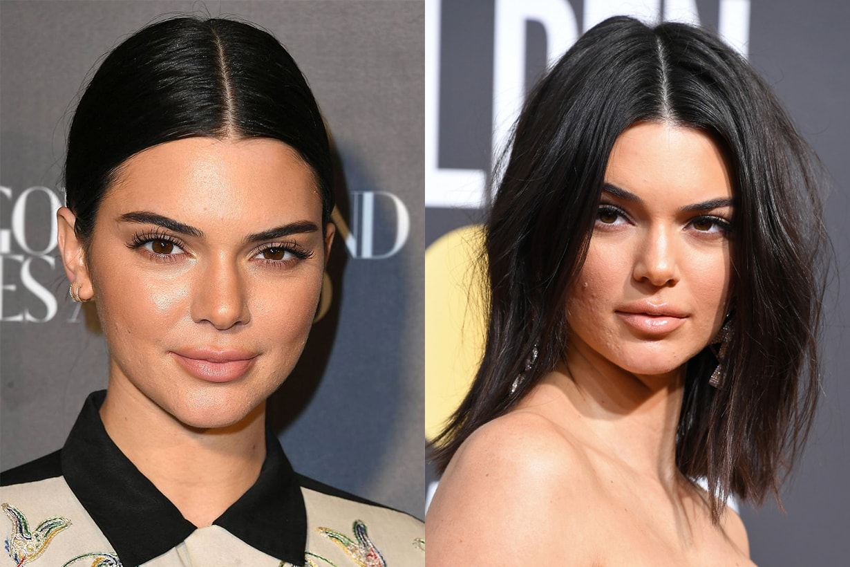 Kendall Jenner Acne