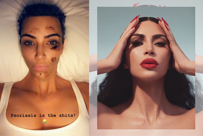 沒想到 Kim Kardashian 長期因為這項皮膚病，而求助於中國草藥偏方？