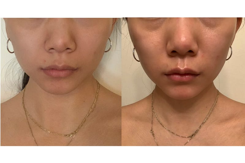 An Editor's Review of the ZIIP GX Beauty Device | Hypebae