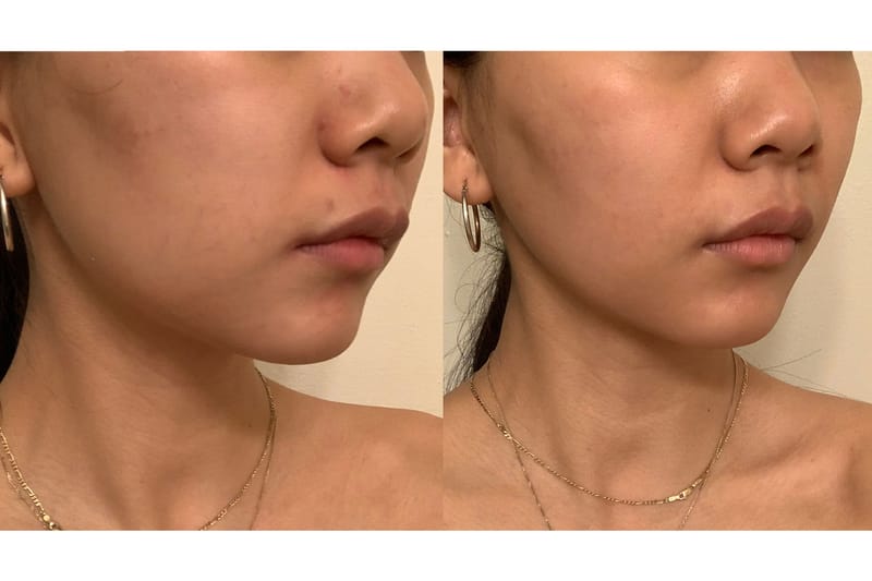 An Editor's Review of the ZIIP GX Beauty Device | Hypebae