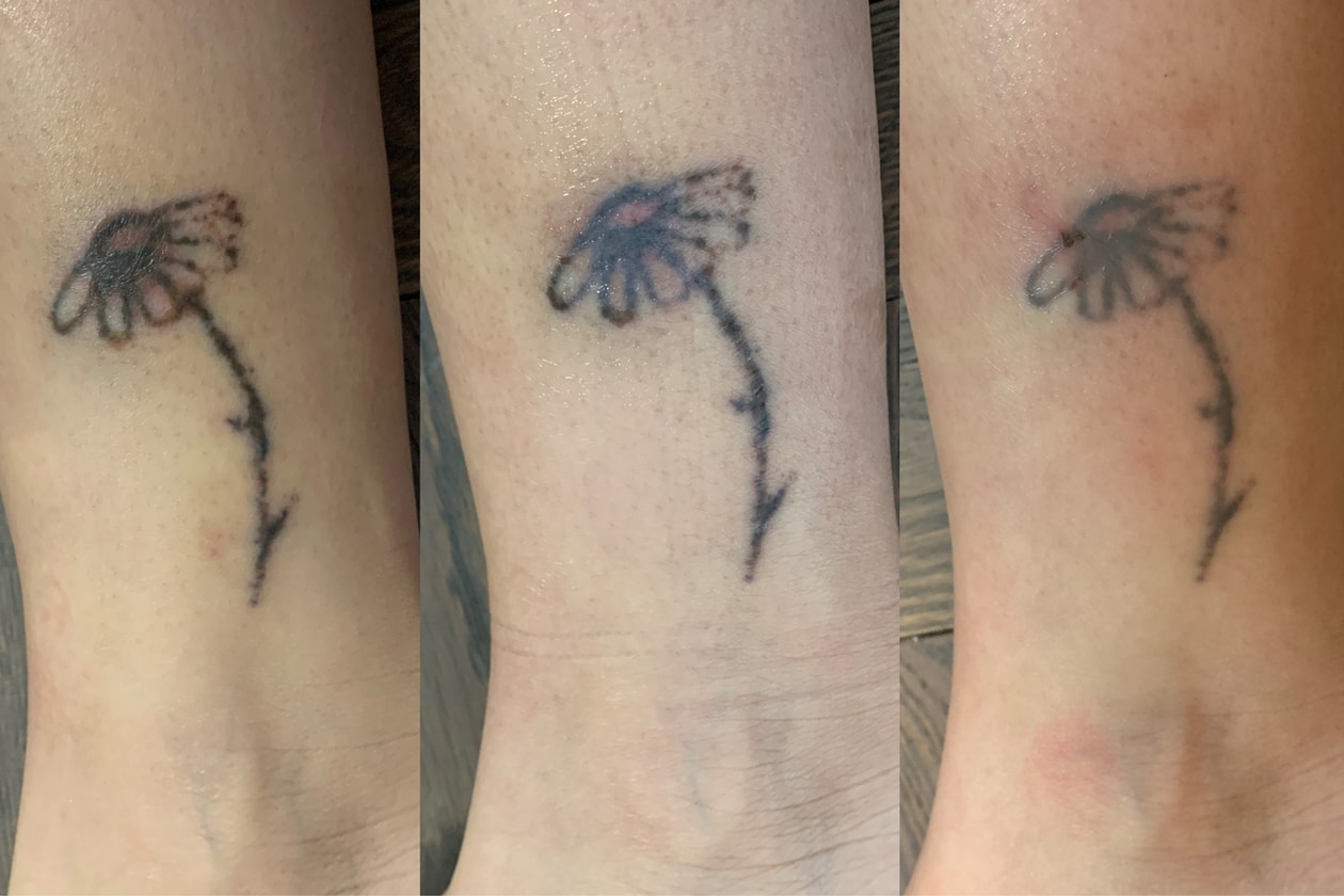 Laser Tattoo Removal What To Expect, My Experience Hypebae