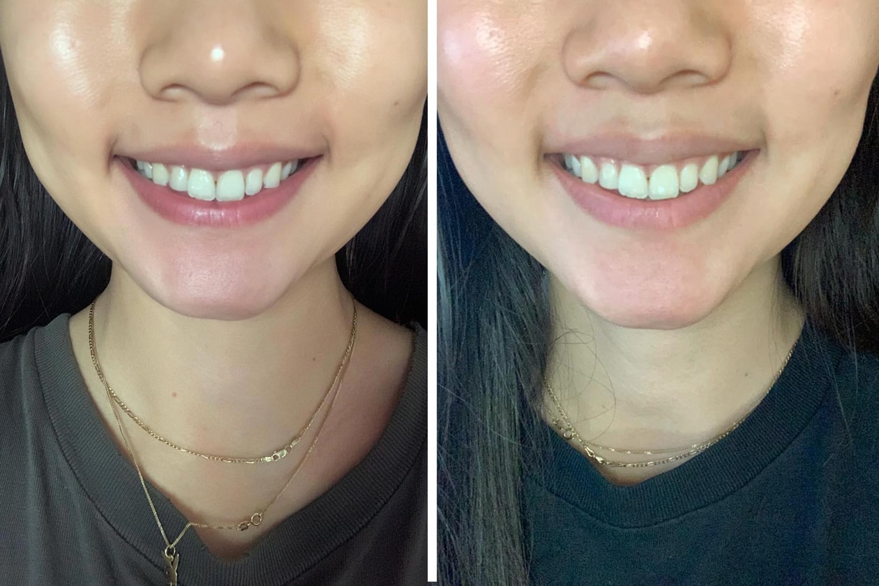 Editor Review of vVardis Teeth Whitening Products Hypebae