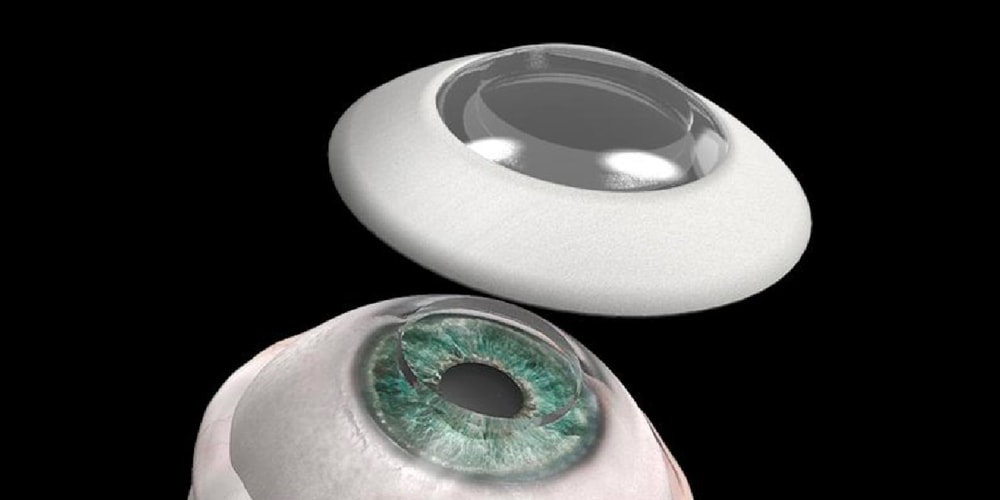 Имплантат искусственной роговицы помог слепому человеку вернуть зрение